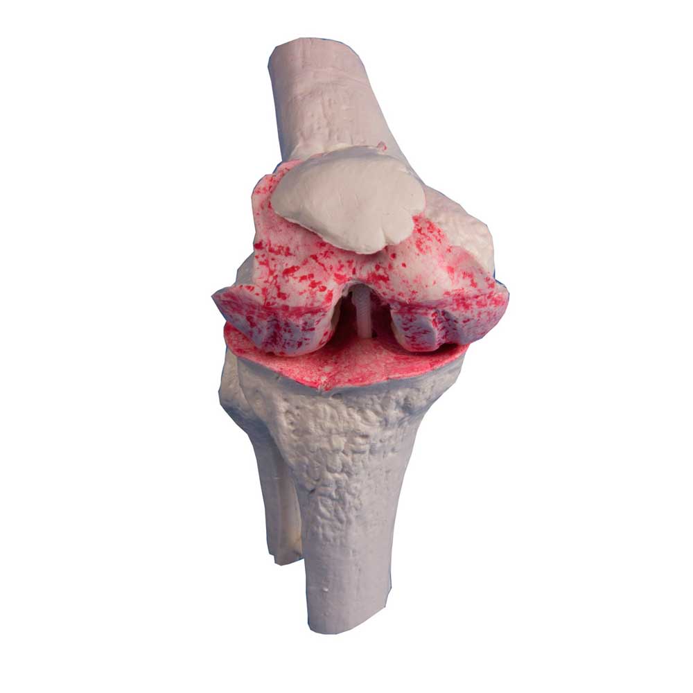 Erler Zimmer Knie-Implantat-Modell, 3 Stck, gesund/erkrankt/Implantat