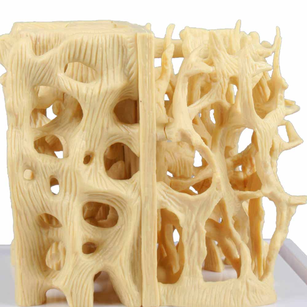 Erler Zimmer Modell - gesunde/osteoporotische Knochenstruktur