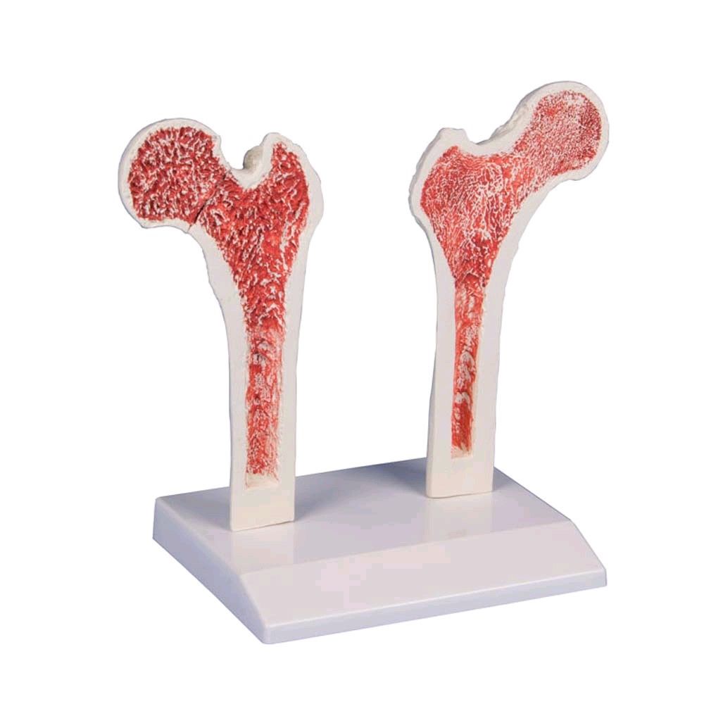 Erler Zimmer Osteoporose-Oberschenkel-Modell anatomisch, lebensgroß