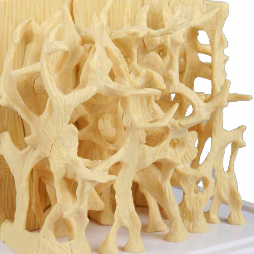 Erler Zimmer Modell - gesunde/osteoporotische Knochenstruktur
