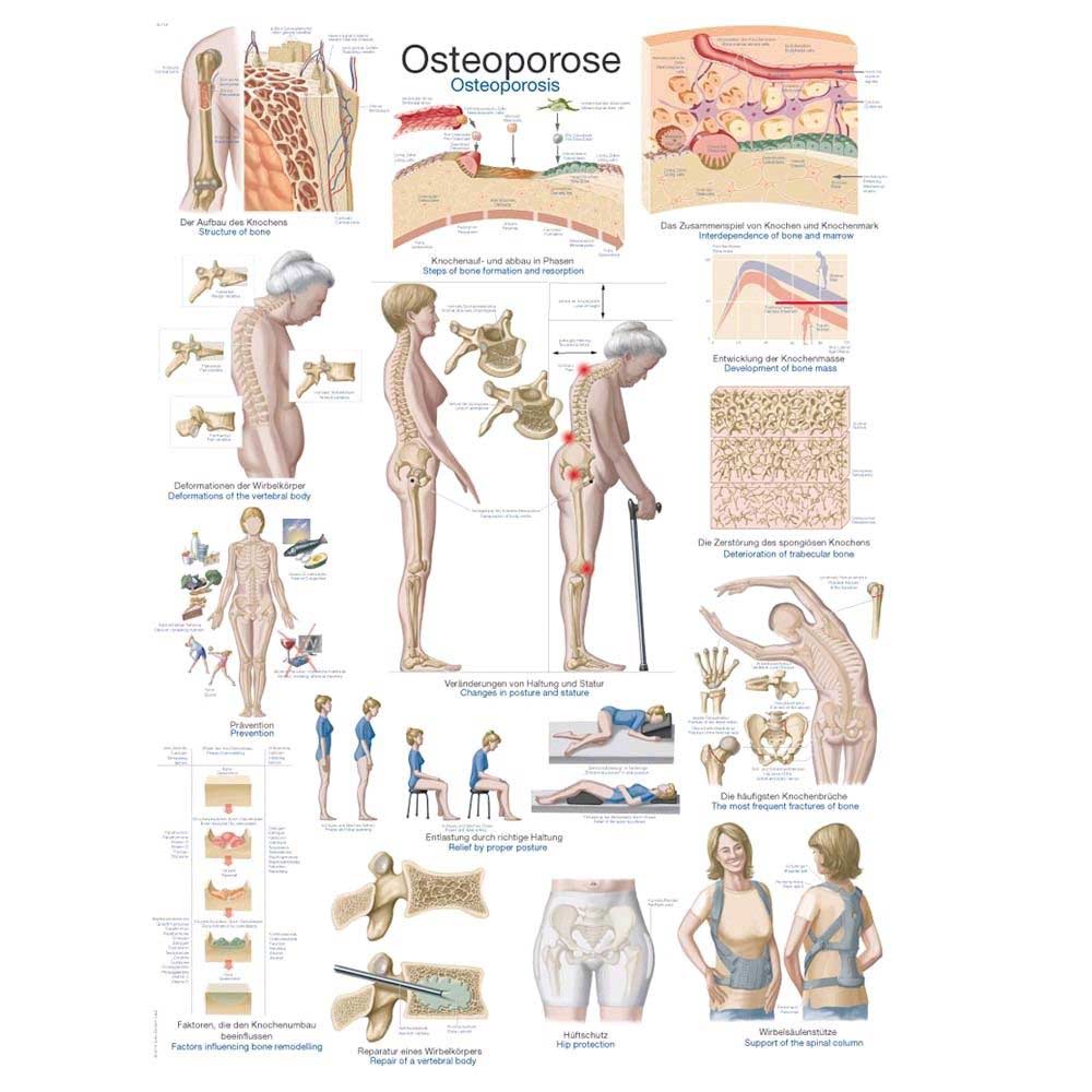 Erler Zimmer anatomische Lehrtafel „Osteoporose“, 50 x 70 cm