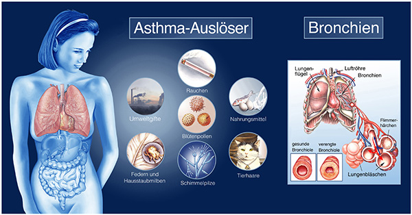 Ein Inhaliergerät kann bei Asthma helfen