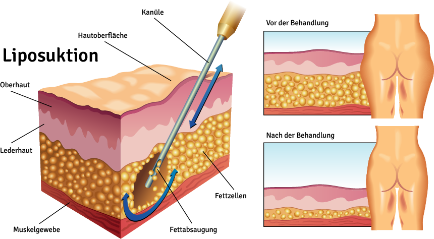  Grafische Darstellung der Liposuktion