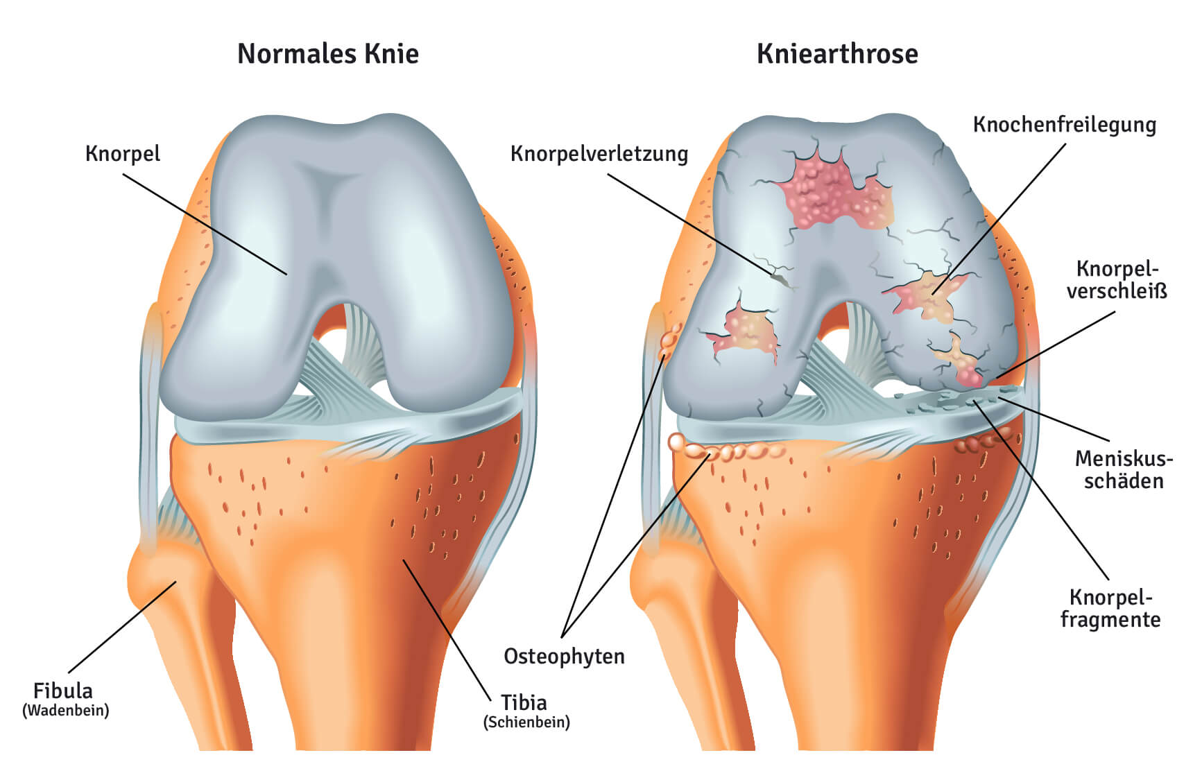 Ein gesundes Kniegelenk im Vergleich zum arthritischen, stark geschädigten Knie