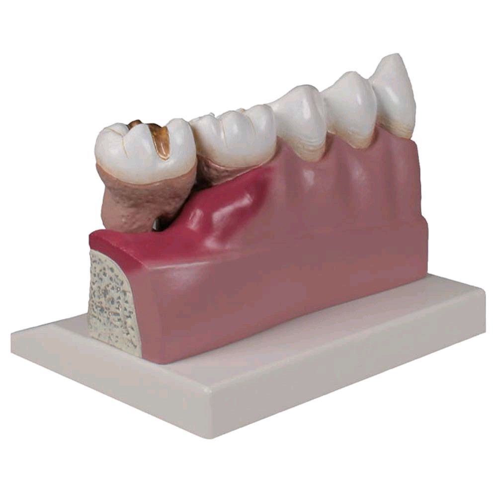 Dentalmodell von Erler Zimmer, Unterkiefer Zahn 3 -7, Erkrankung