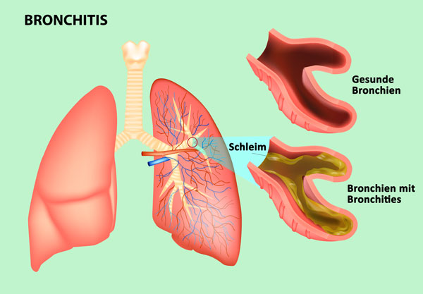 Therapeutische Anwendung eines Inhaliergeräts bei Bronchitis