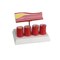 Erler Zimmer Arterienmodell, 4 Schnitte, Verengungen...