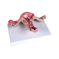 Erler Zimmer Uterusmodell mit Erkrankungen,...
