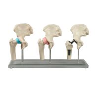 Erler Zimmer verkleinerte Hüft-Implantat-Modelle, 3...