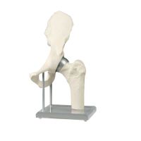 Erler Zimmer Hüftgelenk mit Schalenprothese -...