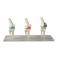 Erler Zimmer Knie-Implantat-Modell, 3 Stck,...